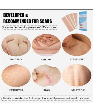 Silicone Scar Sheets - Reusable Scar Removal Strips for Surgical Scars, Keloids, C-Section, Acne, Stretch Marks - Pack of 4 - Buy Online on GoSupps.com