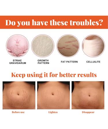 Stretch Mark Repair Essential Oil - 2/3/4PCS Pregnancy & Postpartum Scar Treatment | Prevent & Remove Stretch Marks - Buy Online on GoSupps.com