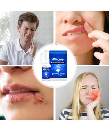 Mund Ulcers Spray - 30ml Mouth Spray for Gum Pain Relief | Refreshing Mint Taste | Fast-Acting Relief for Women and Men - Buy Online on GoSupps.com