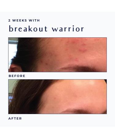 Salicylic Acid Acne Treatment Cream for Oily Skin - Hormonal & Cystic Acne Relief - 90-Day Supply by Ayadara - Buy Online on GoSupps.com