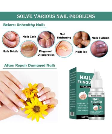 Fungal Nail Treatment + Nail File | Extra Strong Ingrown Toenail Care Oils | Anti Toe Nail Fungus Solution (10ML) - Buy Online on GoSupps.com