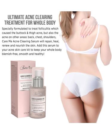 Body Acne Clearing Treatment Serum | Salicylic Acid & Tea Tree Oil | Clear Acne on Buttocks Thighs Back & Chest | 1.37 fl oz - Buy Online on GoSupps.com