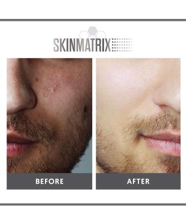 YISHIQI Anti-Blemish Acne Control Pads - Salicylic Lactic & Mandelic Acid for Effective Acne Treatment - Clear Clogged Pores & Eliminate Pimples on Face & Body - Buy Online on GoSupps.com