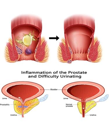 DENGWANG Heca Herbal Hemorrhoid Relief Capsules - Natural Strength, Suppository Treatment (3 Boxes) - Buy Online on GoSupps.com