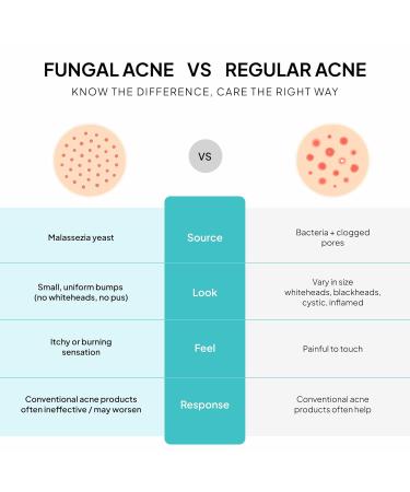 BellamiLuxx Fungal Acne Treatment Lotion: Effective Face & Body Pimple Cream for Bumps Clusters Itch & Redness Fungal Prone Skin Acne Treatment Moisturizer for Teens & Adults with Natural Actives - Buy Online on GoSupps.com