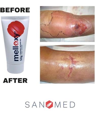 Sanomed Melloxy Wound & Healing Ointment 50g - Natural Gel for Acute Wounds Eczema & Fissured Skin - Medical Honey & Ozonized Olive Oil - Buy Online on GoSupps.com
