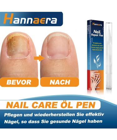 Nail Care Oil Pen Fast Intensive Treatment for Nail Fungus Nourishing & Repairing Damaged Nails (2pcs) | Buy Internationally | eCommerce - Buy Online on GoSupps.com