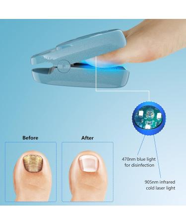 Rechargeable Nail Fungus Treatment Device - Portable Laser Therapy Device for Onychomycosis - Blue - Buy Online on GoSupps.com