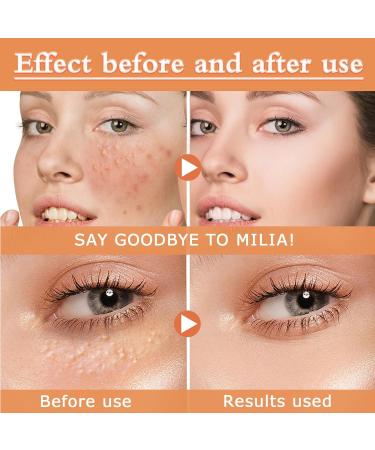 Fat Granule Clearing Skin Essence Milia Clearing Essence Milia Remover Serum Organic Skin Spot Purifying Serum Milia Spot Removal Treatment Helps Dissolve and Reduce Milia - Buy Online on GoSupps.com