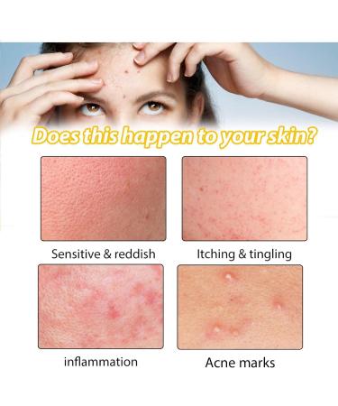 KOAHDE Facial Anti Acne Essence Acne Essence Anti Acne Hydrating Essence Anti Acne Facial Serum Acne Treatment Serum Serum Skin Smoother Acne Removing Moisturizing Serum Skin Rejuvenation Serum - Buy Online on GoSupps.com