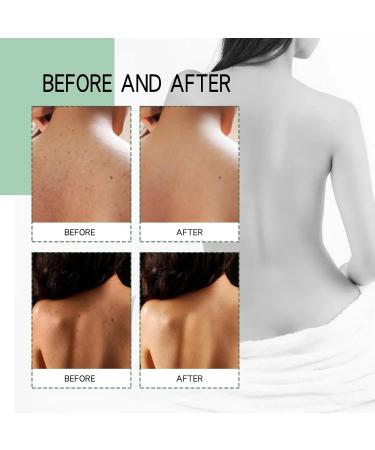 Herbaluxy Back Acne Treatment Spray - Clear Body Acne & Lighten Marks Deep Cleans & Gentle on Skin - Buy Online on GoSupps.com