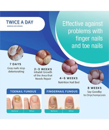 Nail Fungal Treatment Spray - Advanced Toenail & Nail Strengthener Repair - 10ml - Buy Online on GoSupps.com