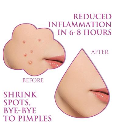 Natural Green Algae & Tea Tree Oil Acne Pimple Patches - Mandabloom Hydrocolloid Dots for Zits, Blemishes & Spots - 72 ct Dermatologist Reviewed - Buy Online on GoSupps.com