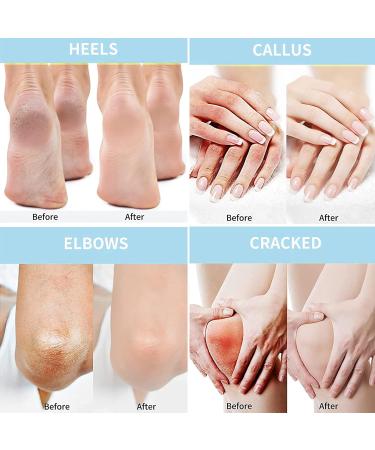 Urea 40% Foot Cream 50g - Cracked Heel Repair & Callus Remover for Dry, Hard Skin - Maximum Strength for Hand, Foot, and Body Care - Buy Online on GoSupps.com