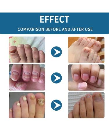 Keratin Nail Growth Oil Nail Strengthener for Damaged Nails - Buy Online on GoSupps.com