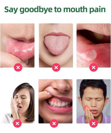 Ulcer Relief Herbal Mouth Spray 20ml - Antiviral Treatment for Canker Sores, Bad Breath, and Dry Mouth - Buy Online on GoSupps.com