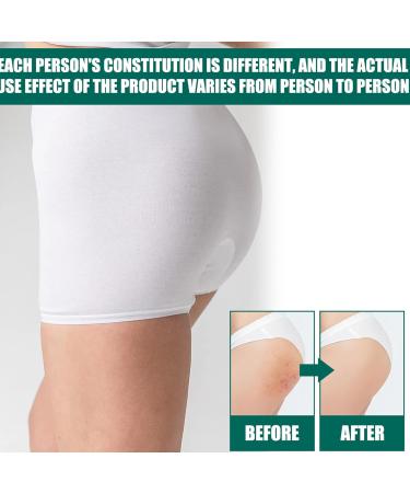 Cr me nettoyante contre l'acn pour les fesses et les cuisses 100 ml de cr me d'acn pour les fesses cr me nettoyante anti-acn cr me anti-boutons sur les fesses limine les boutons et les taches - Buy Online on GoSupps.com