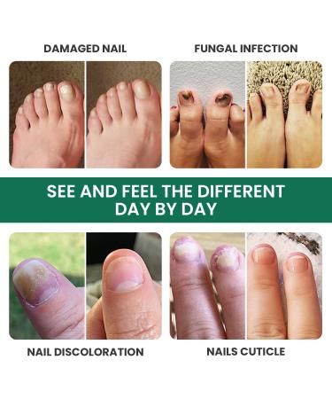 Extra Strength Toenail Fungus Treatment - USA Made Nail Fungus Solution for Thick, Broken & Discolored Nails - Buy Online on GoSupps.com