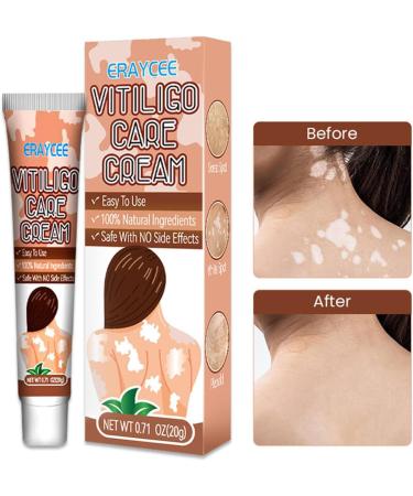  Hongjingda Skin lightening cream for vitiligo - 20g vitiligo relief cream for white patches on the skin reduces white patches improves epidermal melanocytes Hongjingda - Buy Online on GoSupps.com