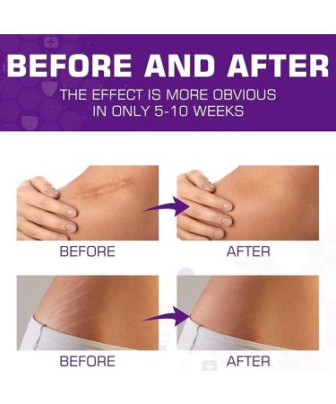Effective Scar Cream for Old & New Scars | Smooth Skin Care - 30 ml | International Shipping Available - Buy Online on GoSupps.com