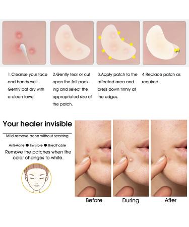 Hydrocolloid Acne Patch - Large Spot Control Stickers for Body Cheek Forehead & Chin | 20 Plasters for Effective Acne Treatment - Buy Online on GoSupps.com