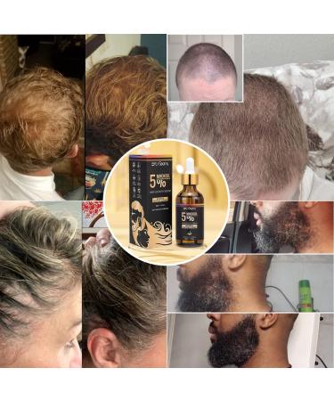 5% Minoxidil & Biotin Hair Growth Serum - 60ML for Men and Women | Hair Regrowth Treatment for Thicker, Longer, Healthier Hair | Prevent Scalp Hair Loss | Natural Formula for Fuller Hair - Buy Online on GoSupps.com