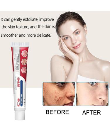 Anti Acne Face Cream Skin Care Beauty with Niacinamide & Vitamin C for Blackheads and Acne Prone Skin Removes Acne Redness Fade Dark Spots Correcting(20g) - Buy Online on GoSupps.com