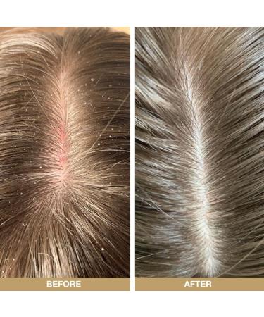 Tea Tree Oil Scalp Kit: Soothes Dry, Itchy, Irritated Scalp | Promotes Healthy Hair, Relief, & Prevention - Buy Online on GoSupps.com