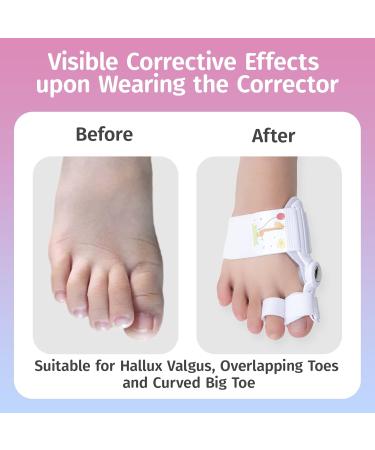 Bunion Corrector for Kids - Adjustable Orthopedic Toe Straightener & Splint for Hallux Valgus Relief (1 Pair - Buy Online on GoSupps.com