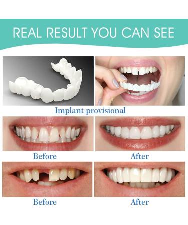Brigtviee Cosmetic Veneers Instant Fake Teeth for Men & Women | Top & Bottom Natural Prosthesis for a Bright Smile - Buy Online on GoSupps.com
