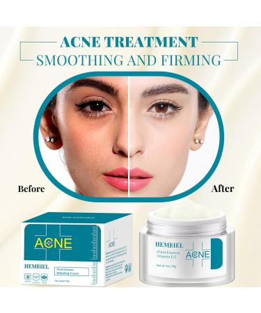 Herbal Acne Cream Anti Acne Face Cream Anti Acne Treatment with Centella And Licorice Extract Spot Cream For Blackheads And Acne Prone Skin Reduces Spot Size Face Moisturiser For All Skin Types - Buy Online on GoSupps.com