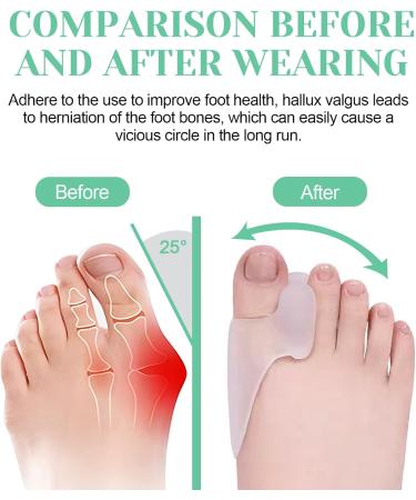 Waymaytecy 6-Piece Toe Spreader | Transparent Silicone Toe Separator for Hallux Valgus & Bunion Correction | Pain Relief for Men & Women - Buy Online on GoSupps.com