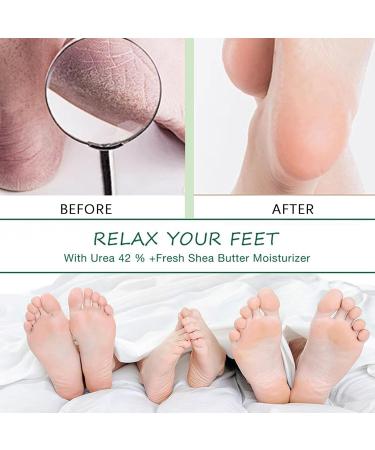 Urea Foot Cream Urea Cream for Feet Urea Foot Cream 40% Foot Cream for Cracked Heels and Dry Skin Deep Moisturizing Callus Remover Nourishes Soften For Feet Knees Hand - Buy Online on GoSupps.com