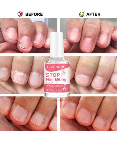 Anti Nail Biting Polish - Stop Biting Nails - Nail Biting Prevention - Stop Nail Repair Clear Varnish - Discourages Nail Biting and Thumb Sucking For Children and Adults - Buy Online on GoSupps.com