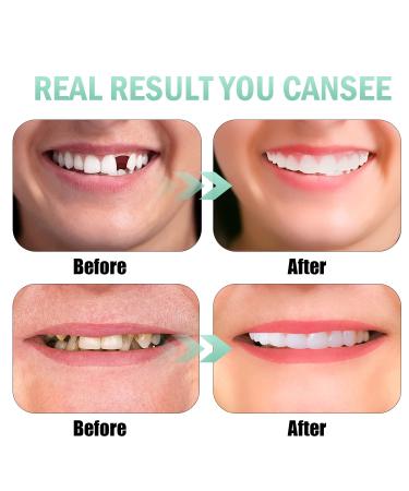 4 PCS Fake Teeth Veneers Dentures Kit for Women and Men - Temporary Dental Veneers for Tooth Repair - Bright White - Protect Your Smile and Boost Confidence - Buy Online on GoSupps.com