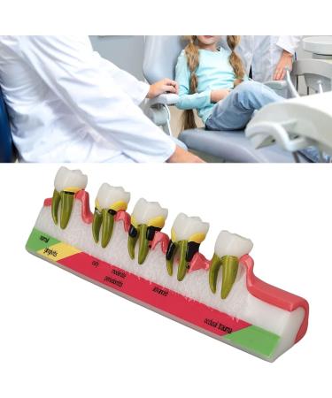 Realistic Dental Periodontitis Model - Study Dental Teeth in Various Stages | Synthetic Resin Educational Tool - Buy Online on GoSupps.com