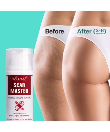 Ebanel Silicone Scar Gel 1 Oz + Hyaluronic Acid Serum Bundle - Advanced Skincare Treatment - Buy Online on GoSupps.com
