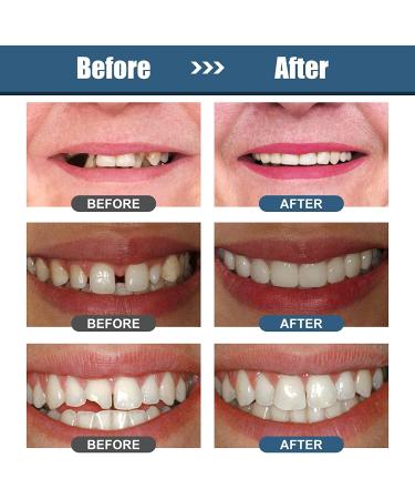 Temporary Tooth Repair Kit - Moldable Thermal Fitting Beads for Broken Teeth, Filling Gaps, and Retouching Tooth Holes - Buy Online on GoSupps.com