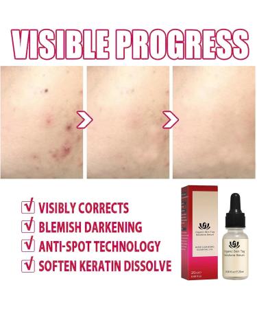 Aibyks 2 Skin Tag Corrector | Natural Mole Remover Cream Natural Skin Tag Removal Mole Corrector for Face Wart and Body Wart - Buy Online on GoSupps.com