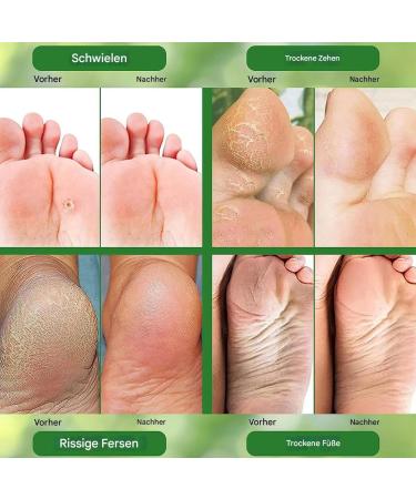  Generisch Foot Cream - Nourishing Cream for Dry Skin - 50g - Gentle Care Gel for Chapped Skin and Heels - Specially Designed to Prevent Dry and Chapped Skin - Buy Online on GoSupps.com