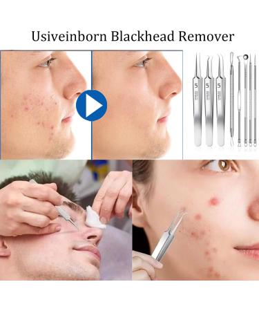 Usiveinborn Blackhead Remover Usiveinborn Tweezers Usiveinborn Professional Stainless Steel Facial Blackhead Remover Tweezers (Set* B) - Buy Online on GoSupps.com