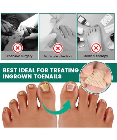 Patchs Pour Ongles Cass s 50 Pi ces Pansements De Soin Respirants | R paration Nourrissante Pour Ongles De Pied F l s Pour Bandage Des Cass s Ab m s Et Bless s La Maison Pour Pieds - Buy Online on GoSupps.com
