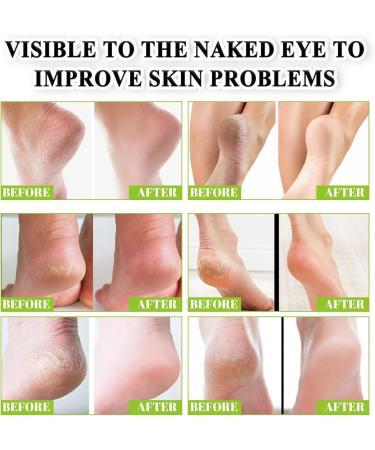 Urea 42% Foot Cream Cracked Heel Repair Cream For Feet and Hand Callus Remover For Dry And Hard Skin Hydrating Foot Moisterizer Nourishes Soften for Feet Knees Hand 100g - Buy Online on GoSupps.com