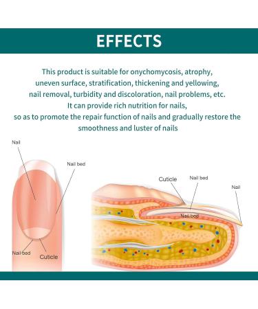 ?? ?? Fungal Nail Treatment-Nail Repair Essence For Toenails Extra Strong-Nail Fungus Serum For Toenail-Natural Anti Fungal Nail Serum Fungal Nail Polish For Finger And Toe Nail Fungal - Buy Online on GoSupps.com