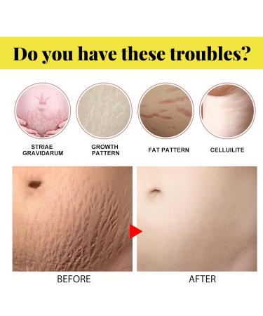 Best Stretch Marks Cream for Scar Removal | Repair & Reduce Skin Stripes - 30g - Buy Online on GoSupps.com