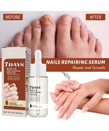 GFOUK 7 Days Nail Growth and Strength Serum Set - Nail Repair and Growth Oil for Toenail Treatment (2 Pcs) - Buy Online on GoSupps.com