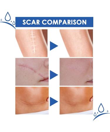 3PCS Scar Removal Gel - Medical Grade Lotion for All Scars & Stretch Marks - Buy Online on GoSupps.com