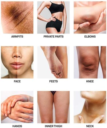 Dark Spot Corrector Cream for Body | Age/Sun/Brown Spot Treatment | Hyperpigmentation Remover | Instant Results | Moisturizes Armpit, Neck, Knees & Private Parts - Buy Online on GoSupps.com