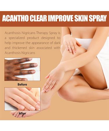 OAKITA Acanthoclear Therapy Spray - Acanthosis Nigricans Treatment for Dark Knuckle - 1PCS/2PCS - Buy Online on GoSupps.com