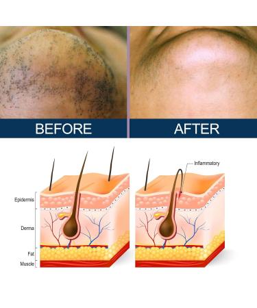Ingrown Hair Treatment - 30ml Razor Bumps Solution | Mild Moisturizing After Shave Repair Serum for Men - Buy Online on GoSupps.com